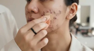 Close-up of a makeup artist dabbing full coverage concealer for acne scars onto textured skin using a beauty sponge.